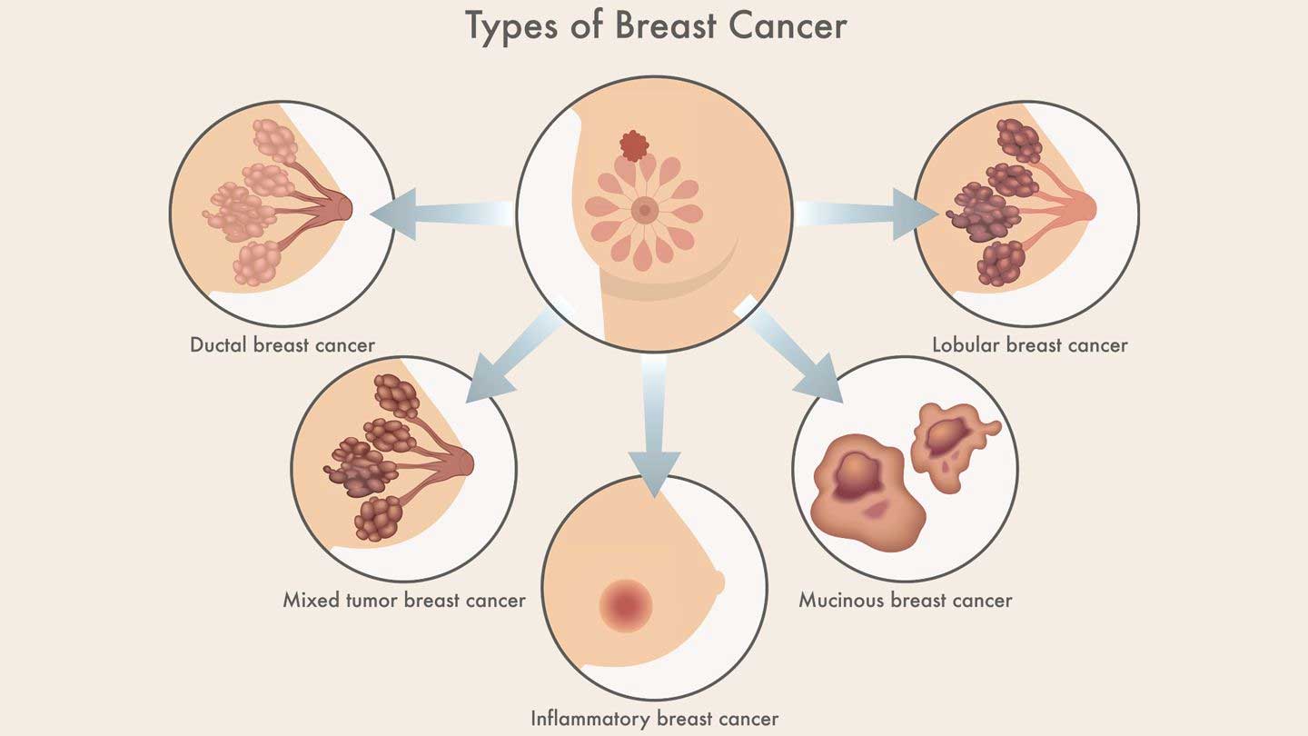 Types-of-breast-cancer