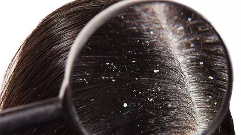 How-to-Get-Rid-of-Dandruff